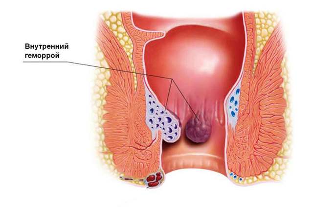Геморройные узлы - лечение и способы убрать (удалить) недуг