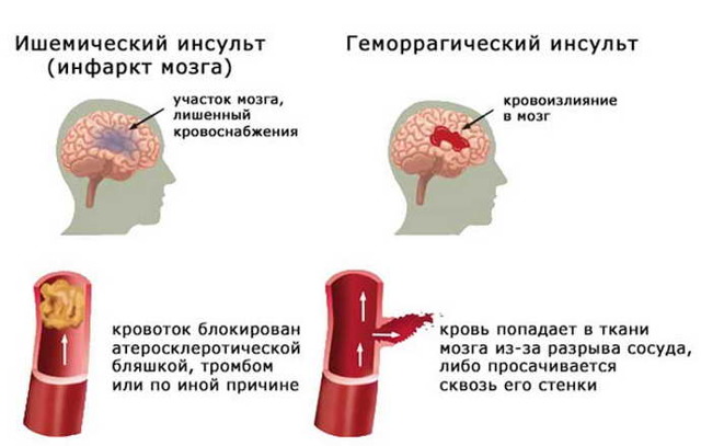 Препараты для улучшения мозгового кровообращения в таблетках, инъекциях или капельницах