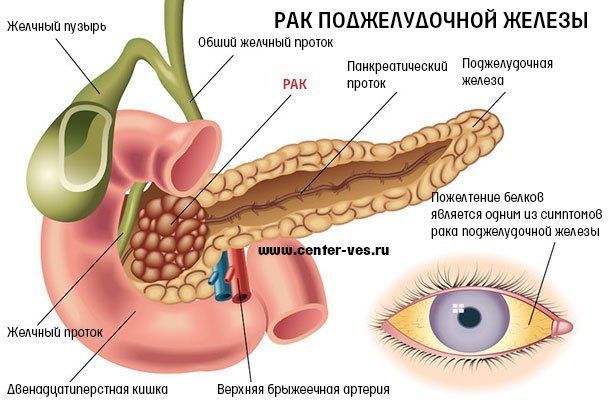 Рак поджелудочной железы - причины, симптомы, диагностика и лечение, прогноз