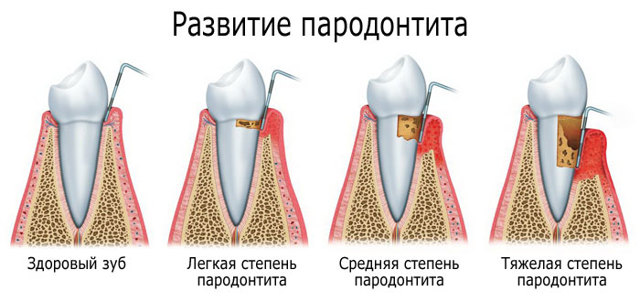 После удаления зуба болит голова