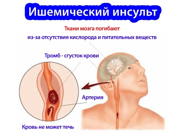 Ишемический инсульт головного мозга: лечение, восстановление и возможные последствия