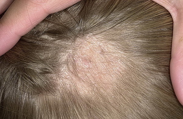 Что такое микоз волосистой части головы и как его лечить?