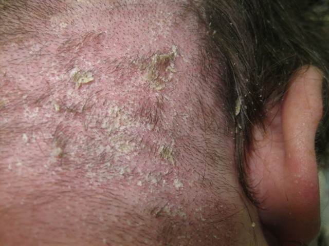 Псориаз кожи головы – лучшее лечение, симптомы и причины