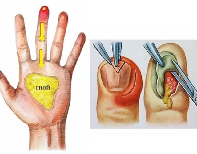 Как лечить нарыв на пальце возле ногтя (на руке, ноге), чем вылечить