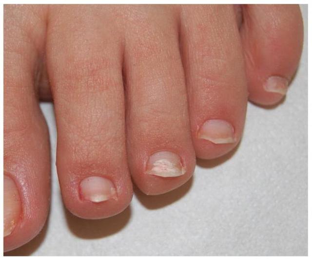 Полоски на ногтях их причины и лечение