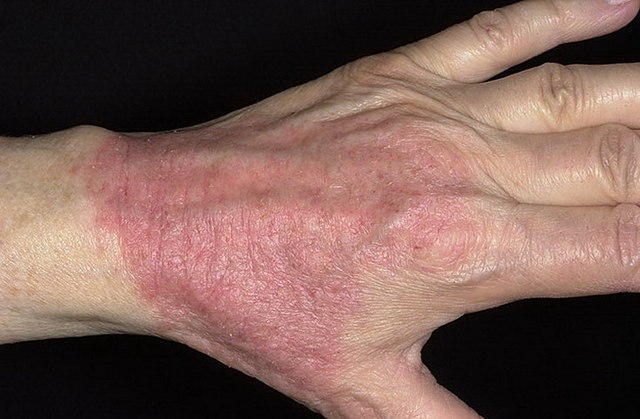 Атопический дерматит на руках у взрослого и ребенка (фото): причины и лечение