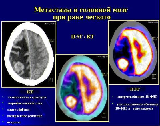 Метастазы в головном мозге: продолжительность жизни, симптомы, лучевая терапия при метастазах мозга