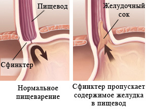 Недостаточность кардиального жома