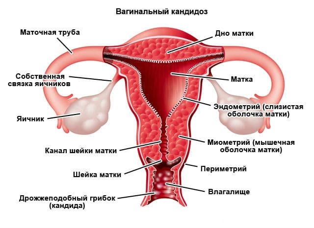 Грибок во влагалище: причины, симптомы и лечение вагинального кандидоза