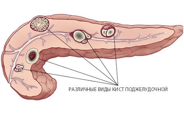 Полипы в поджелудочной железе: причины и лечение