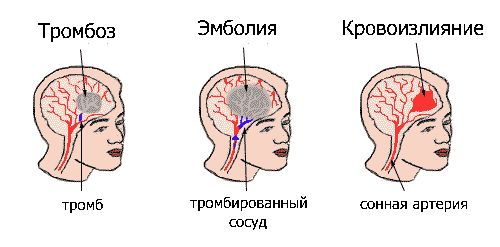 Тошнота после гриппа: остаточное явление или симптом осложнения