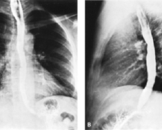 Подготовка к рентгену желудка, рентгеноскопия кишечника и пищевода