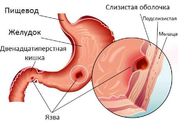 Рентгеноскопия желудка с барием: подготовка, методика проведения, результаты