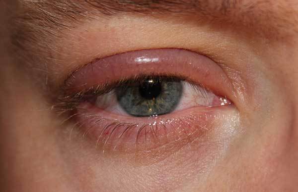 Аллергия на веках глаз - мазь от красных пятен