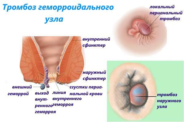 Внутренний и наружный геморрой: чем отличается лечение