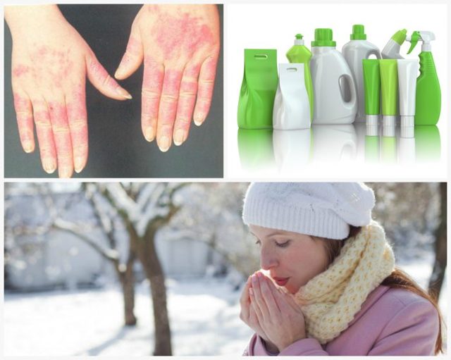 Как лечить покраснение и шелушение кожи между пальцами рук
