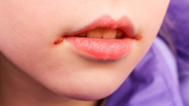 ТОП5 инфекций через поцелуй: чем можно заболеть при поцелуе?