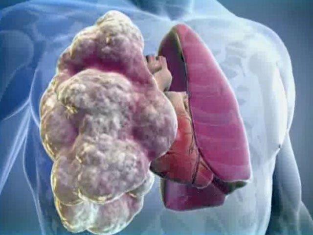 Аллергическая астма: симптомы и лечение
