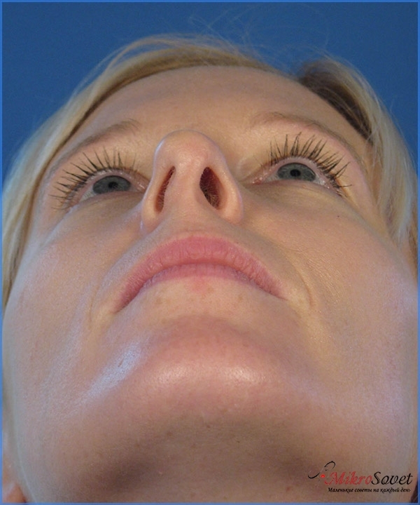 Септопластика носовой перегородки: отзывы, цена, фото до и после, лазерная, эндоскопическая и другие виды коррекции носа, последствия, возможные осложнения и реабилитация после операции