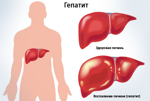 Бывает ли температура при заболевании печени