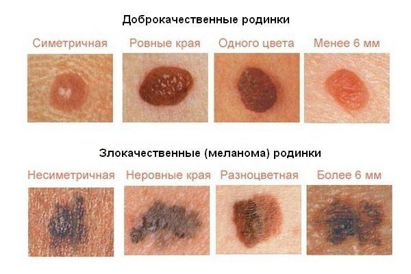 Пятна на коже - диагностика по цвету, локализации, сухости и зуду