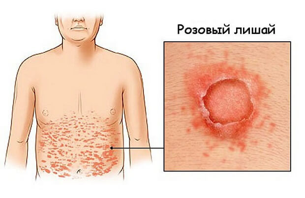 Красные пятна на животе и спине с шелушением и без: причины и лечение
