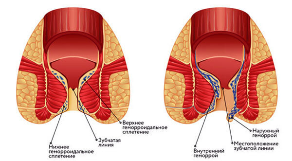 Внутренний и наружный геморрой: чем отличается лечение