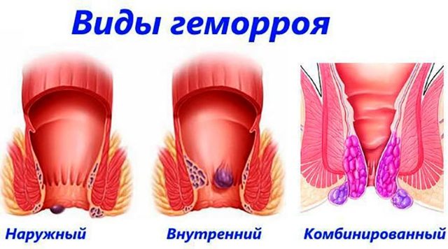 Внутренний и наружный геморрой: чем отличается лечение