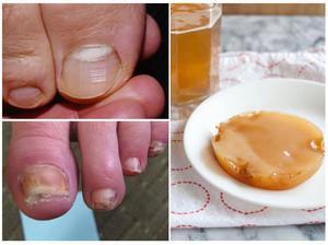 Народные средства от грибка ногтей на ногах - действенные способы и рецепты для домашнего лечения