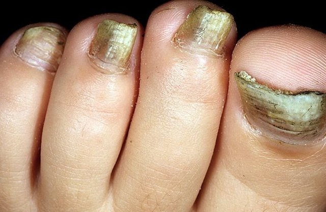 Что такое грибок ногтей на ногах - как выглядит и виды заболевания, симптомы и средства терапии