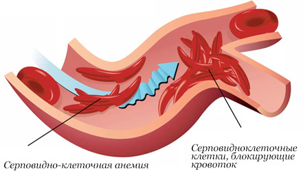 Продукты богатые железом при анемии