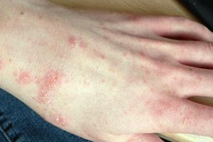 Кожные болезни кожи у человека – фото и название, лишай, дерматит, чесотка, лечение
