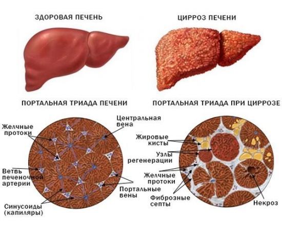 Умеренные диффузные изменения паренхимы печени