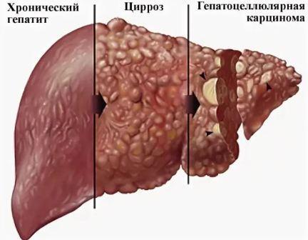 Умеренные диффузные изменения паренхимы печени