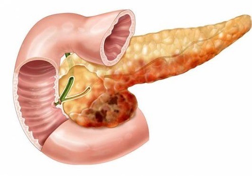 Панкреонекроз поджелудочной железы: прогноз после операции, последствия, летальный исход