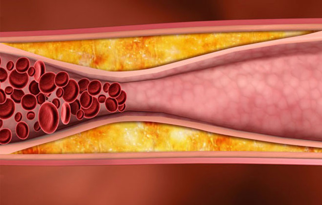 Лекарство от холестериновых бляшек