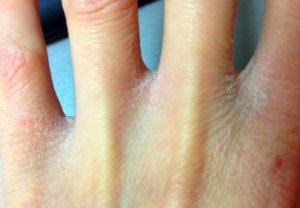 Грибок между пальцами рук – лечение