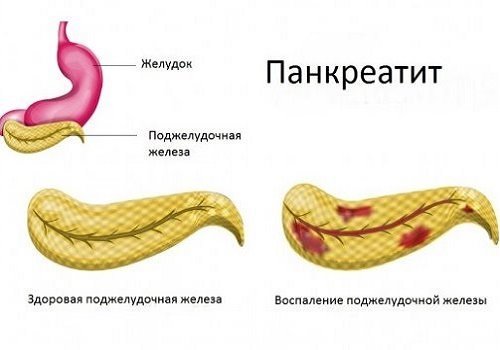 Как восстановить поджелудочную железу: таблетки для поджелудочной железы