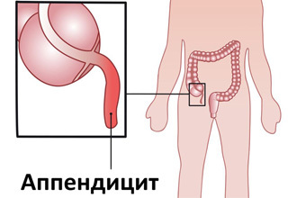 Может ли быть понос при аппендиците и как его лечить