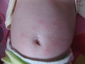 Почему возникает у ребенка сыпь на животе и что делать с недугом?