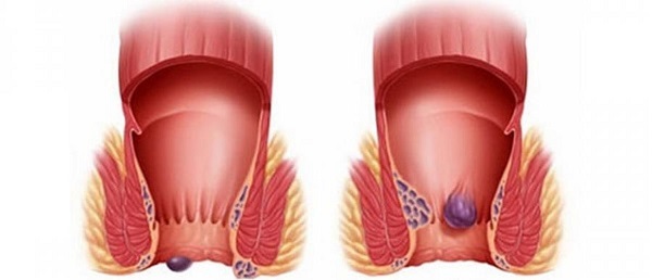 Внутренний и наружный геморрой: чем отличается лечение