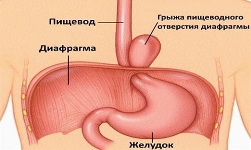 Диафрагмальная грыжа у детей: причины, симптомы, диагностика, лечение