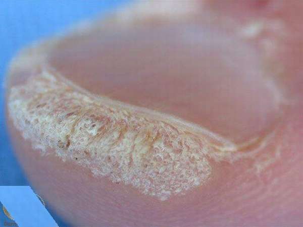 Доброкачественные опухоли ногтя и возле ногтя