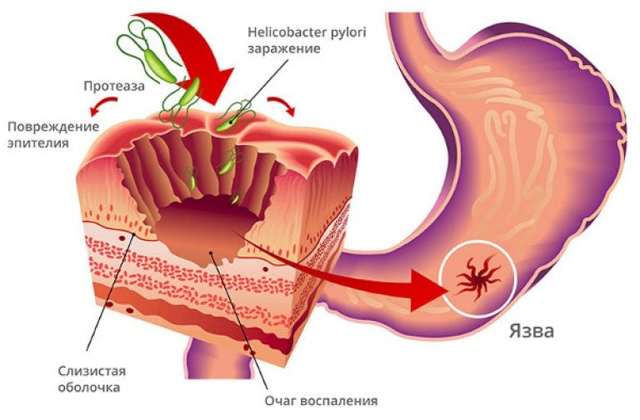 Эрозия желудка - симптомы и лечение заболевания