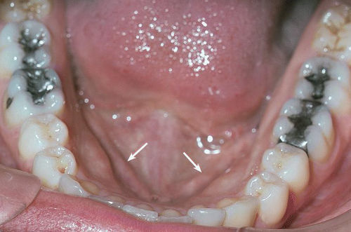 Воспаление слюнной железы под языком: причины, симптомы и лечение опухоли под языком