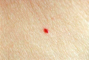 От чего на теле появляются маленькие мелкие красные точки – что это у ребенка, у взрослого, фото