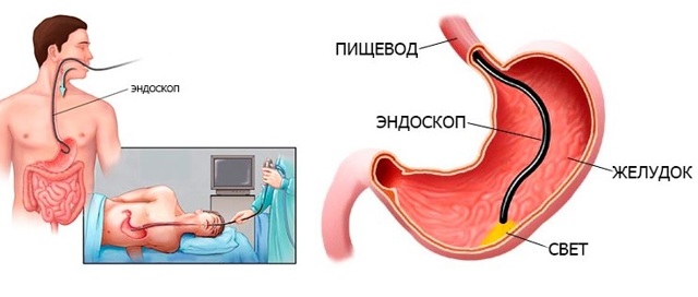 Показания и противопоказания к проведению процедуры ФГДС