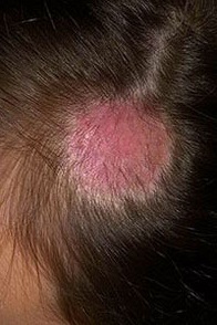 Микроспория гладкой кожи: симптомы, диагностика и лечение