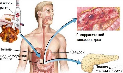 Геморрагический панкреонекроз
