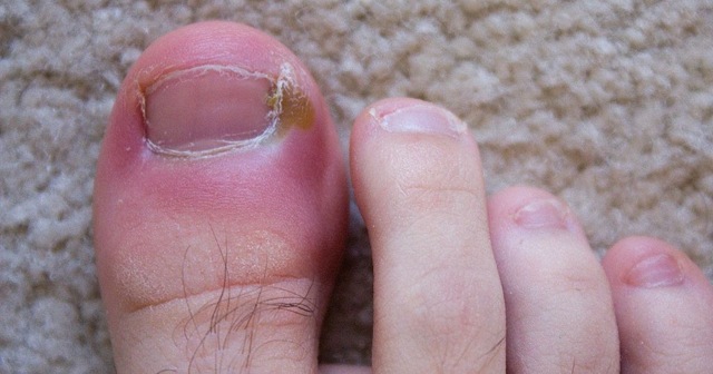 Нарывает палец на ноге возле ногтя: лечение и профилактика